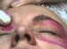 Piling Around The Eye